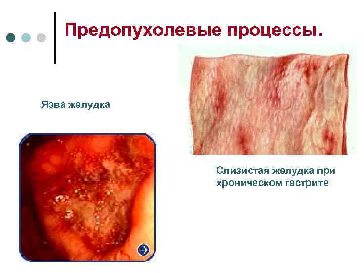   Предопухолевые процессы.  Язва желудка     Слизистая желудка при