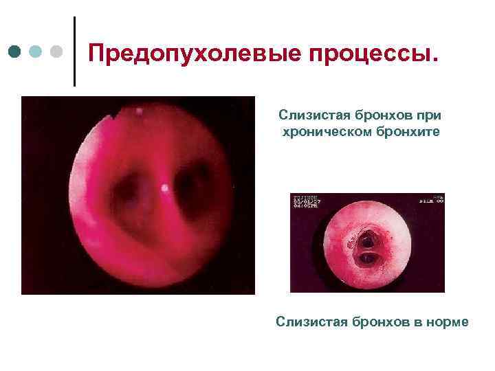 Слизистая бронхов