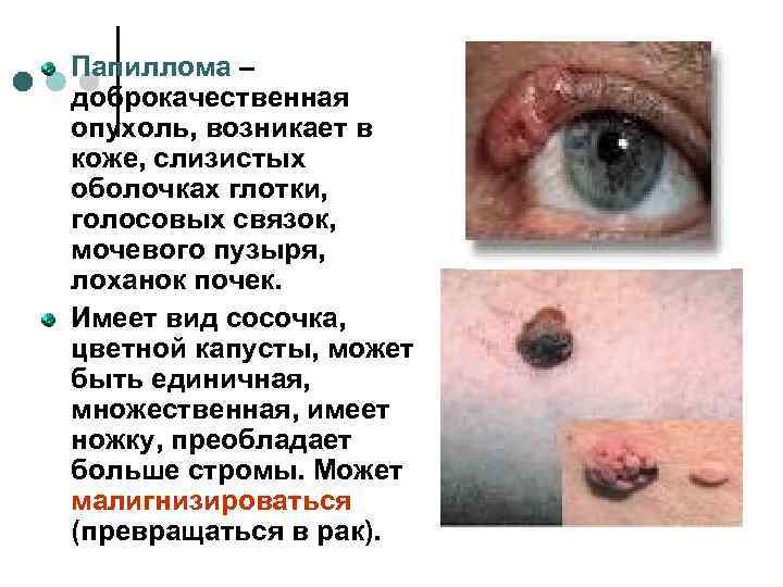 Папиллома – доброкачественная опухоль, возникает в коже, слизистых оболочках глотки, голосовых связок, мочевого пузыря,
