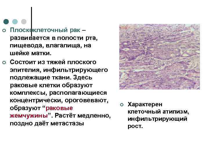 ¢  Плоскоклеточный рак – развивается в полости рта, пищевода, влагалища, на шейке матки.