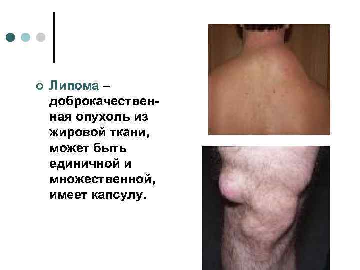 ¢  Липома – доброкачествен- ная опухоль из жировой ткани, может быть единичной и