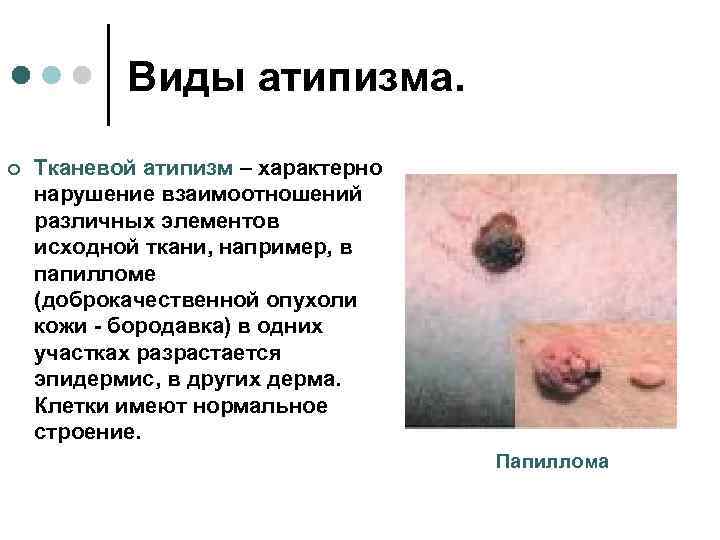   Виды атипизма.  ¢  Тканевой атипизм – характерно нарушение взаимоотношений различных