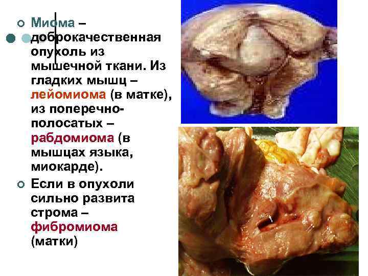 ¢  Миома – доброкачественная опухоль из мышечной ткани. Из гладких мышц – лейомиома