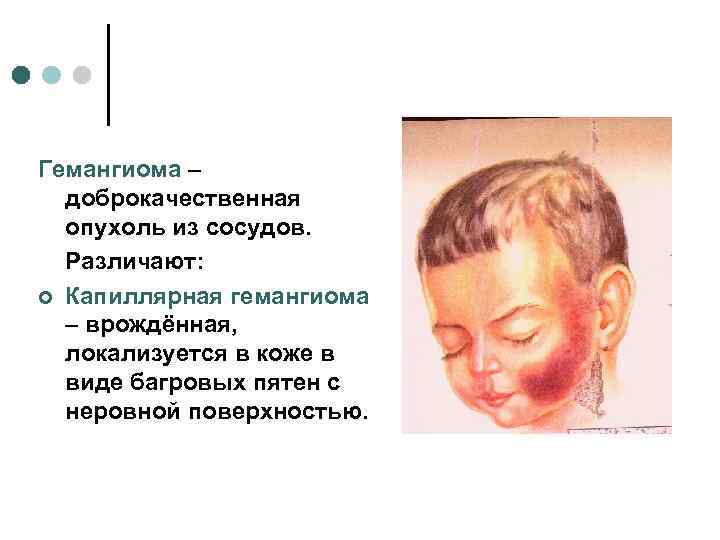 Гемангиома –  доброкачественная  опухоль из сосудов.  Различают: ¢ Капиллярная гемангиома 