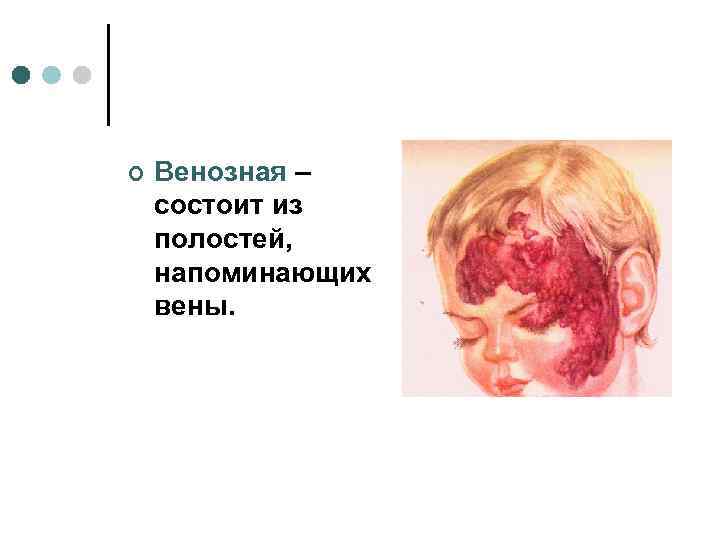 ¢  Венозная – состоит из полостей, напоминающих вены. 