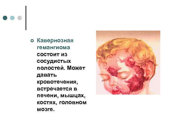 ¢  Кавернозная гемангиома состоит из сосудистых полостей. Может давать кровотечения, встречается в печени,