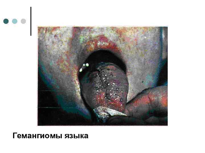 Гемангиомы языка 