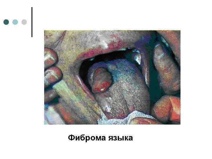 Фиброма языка 