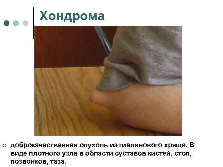   Хондрома ¢  доброкачественная опухоль из гиалинового хряща. В виде плотного узла