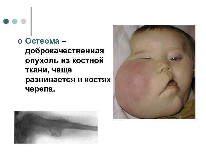 ¢  Остеома – доброкачественная опухоль из костной ткани, чаще развивается в костях черепа.