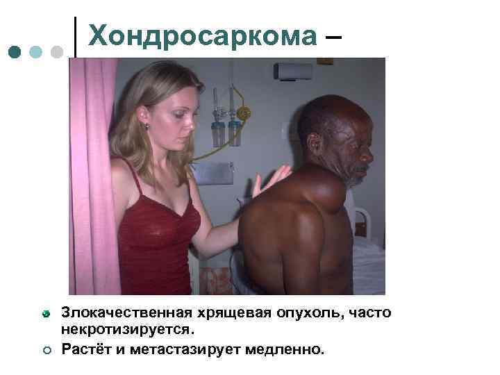   Хондросаркома –   Злокачественная хрящевая опухоль, часто некротизируется. ¢  Растёт