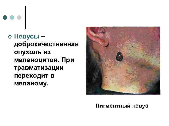 ¢  Невусы – доброкачественная опухоль из меланоцитов. При травматизации переходит в меланому. 