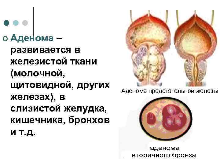 ¢ Аденома – развивается в железистой ткани (молочной,  щитовидной, других   