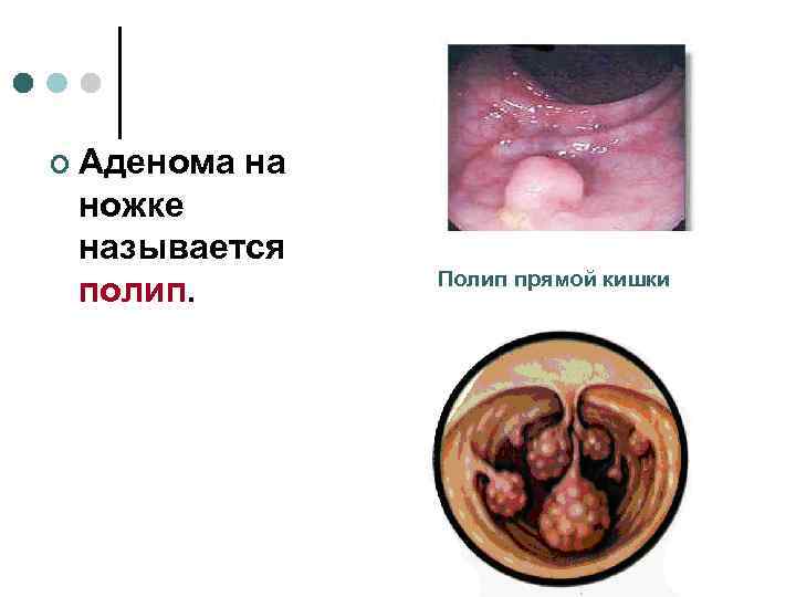 ¢ Аденома  на ножке называется   Полип прямой кишки полип. 
