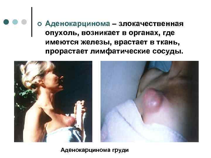 ¢  Аденокарцинома – злокачественная опухоль, возникает в органах, где имеются железы, врастает в