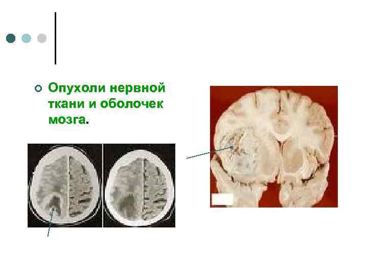 ¢  Опухоли нервной ткани и оболочек мозга 