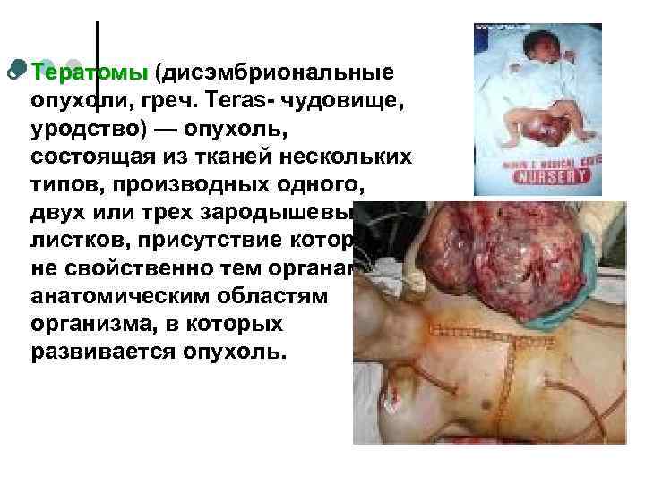 ¢  Тератомы (дисэмбриональные опухоли, греч. Teras- чудовище, уродство) — опухоль, состоящая из тканей