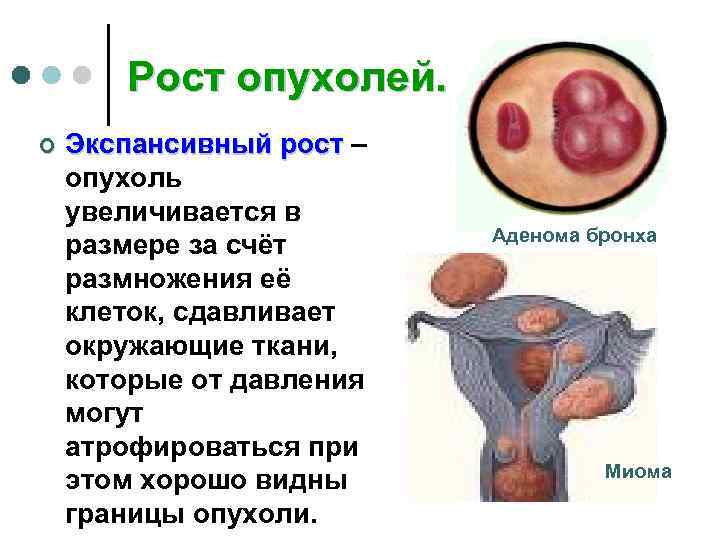   Рост опухолей. ¢  Экспансивный рост – опухоль увеличивается в  