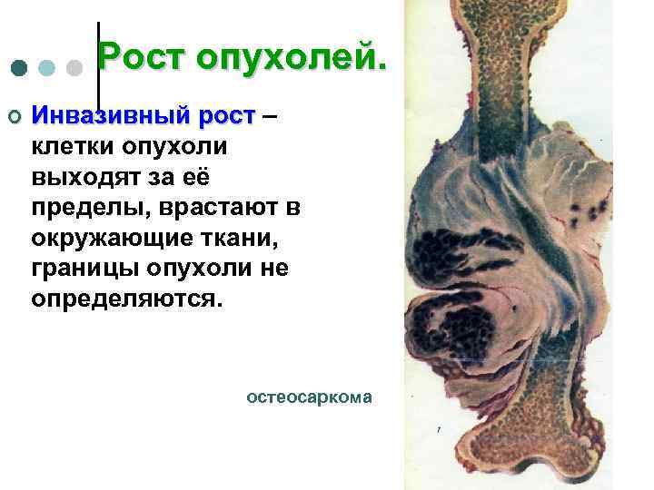 Рост опухоли