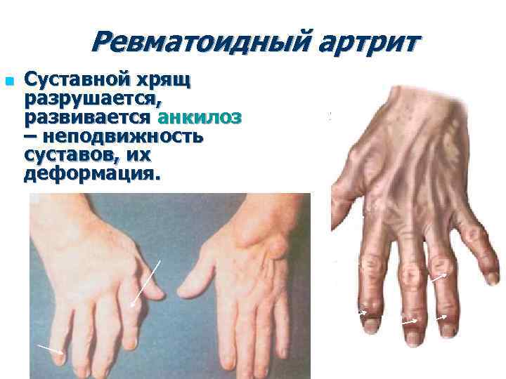 Ревматоидный артрит n Суставной хрящ разрушается, развивается анкилоз – неподвижность суставов, их деформация. 