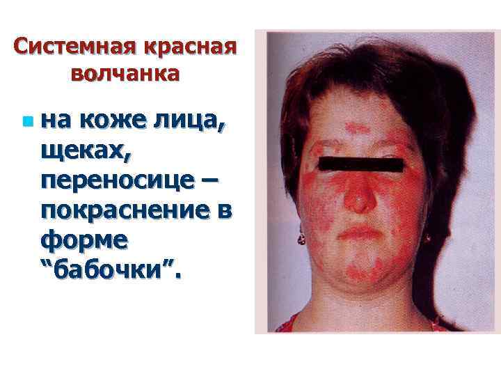 Системная красная волчанка n на коже лица, щеках, переносице – покраснение в форме “бабочки”.