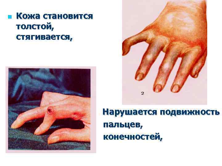 n Кожа становится толстой, стягивается, Нарушается подвижность пальцев, конечностей, 