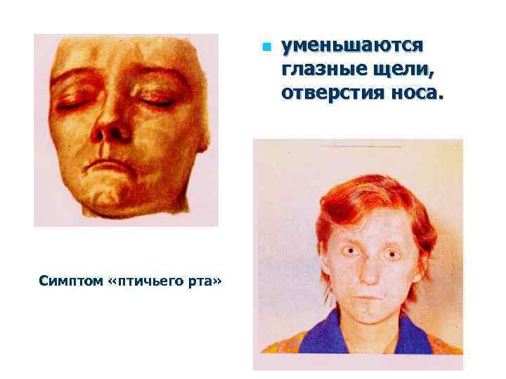 n Симптом «птичьего рта» уменьшаются глазные щели, отверстия носа. 