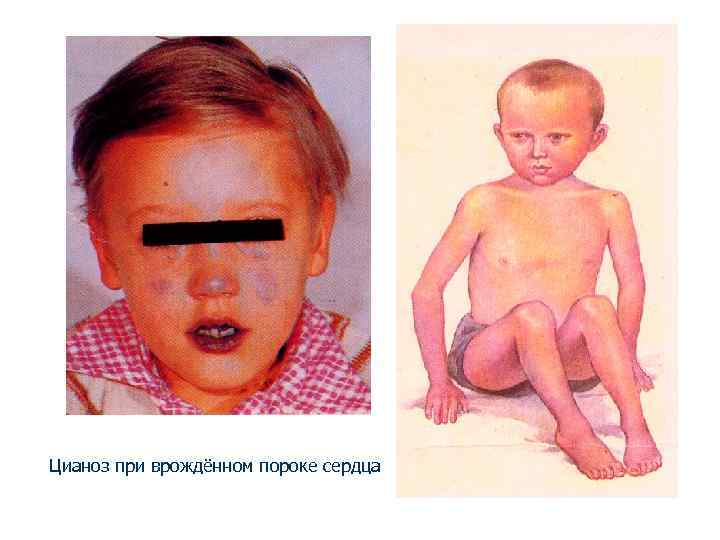 Цианоз при врождённом пороке сердца 
