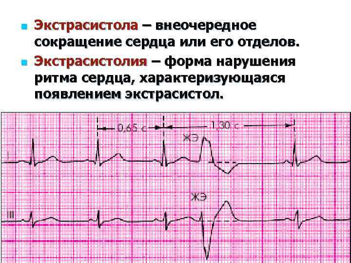 Экстрасистолы в сутки. Экстрасистолия на ЭКГ. ЭКГ экстрасистолия ритм. Что такое желудочковые экстрасистолы сердца. Желудочковая экстрасистолия на ЭКГ ритм.