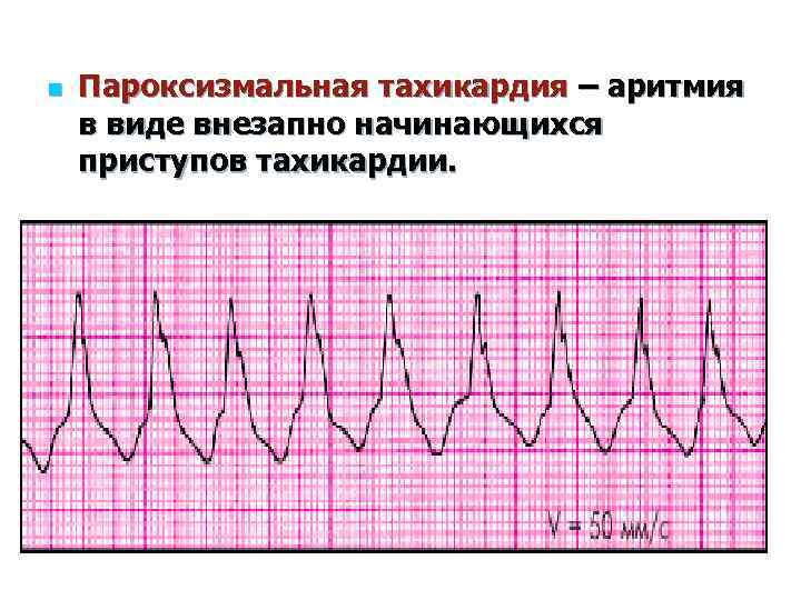 Аритмия и тахикардия. Аритмия тахикардия. Мерцательная аритмия тахикардия. Пароксизмальная аритмия. Экстрасистолия и пароксизмальная тахикардия.