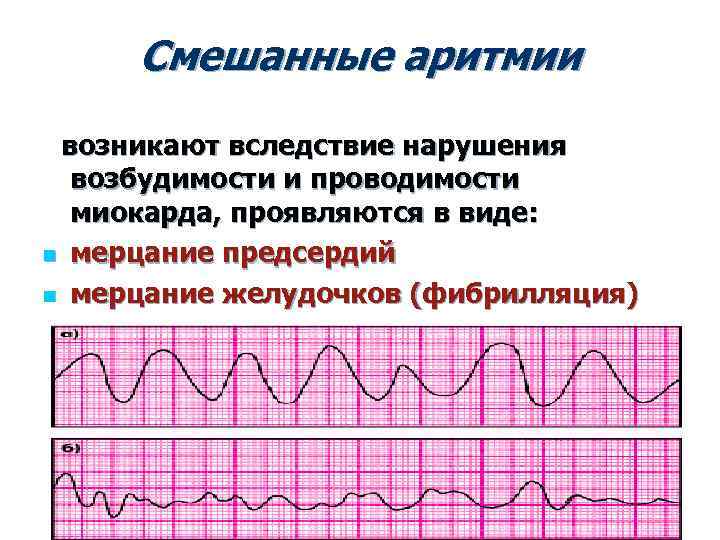 Аритмии возбудимости