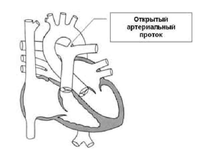 Коарктация аорты гемодинамика схема