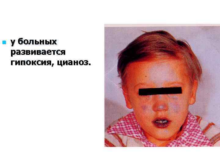 n у больных развивается гипоксия, цианоз. 