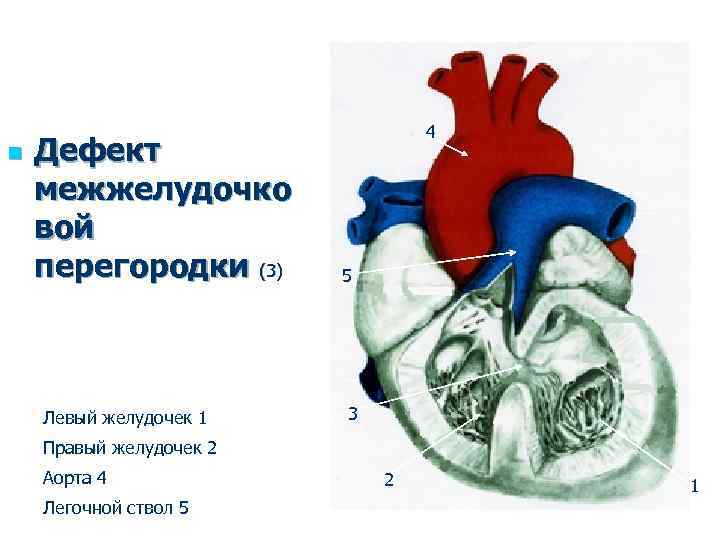 У человека левый желудочек. Сердце трехкамерное с одним общим желудочком. ВПС единственный желудочек. Единый желудочек сердца порок. Двуприточный левый желудочек.