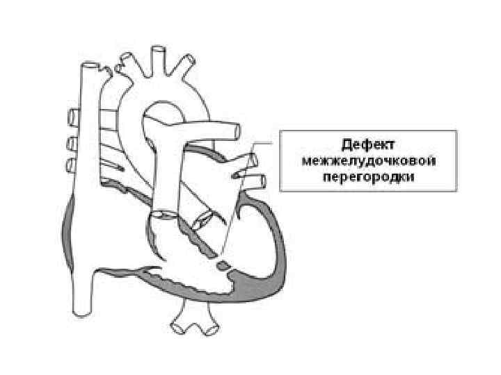 Дефект межжелудочковой перегородки