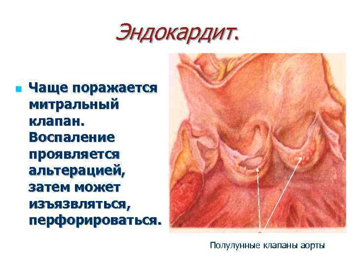 Эндокардит. n Чаще поражается митральный клапан. Воспаление проявляется альтерацией, затем может изъязвляться, перфорироваться. Полулунные