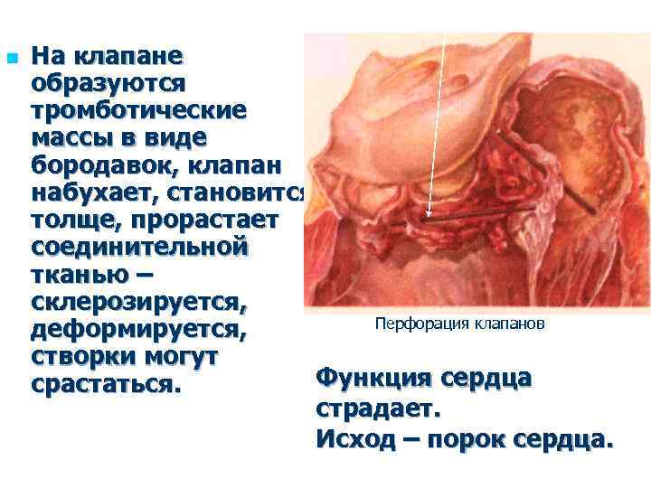 n На клапане образуются тромботические массы в виде бородавок, клапан набухает, становится толще, прорастает