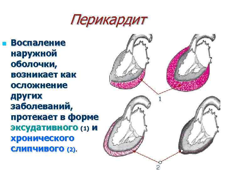 Перикардит n Воспаление наружной оболочки, возникает как осложнение других заболеваний, протекает в форме эксудативного
