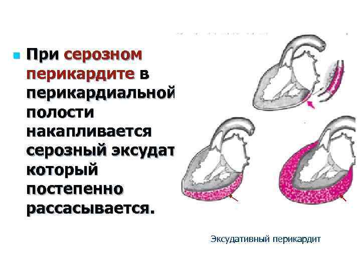 n При серозном перикардите в перикардиальной полости накапливается серозный эксудат, который постепенно рассасывается. Эксудативный