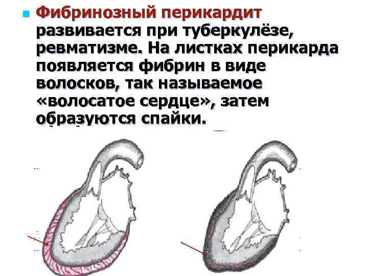 n Фибринозный перикардит развивается при туберкулёзе, ревматизме. На листках перикарда появляется фибрин в виде