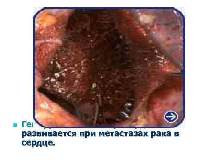 n Геморрагический перикардит развивается при метастазах рака в сердце. 