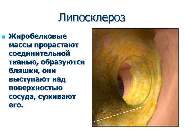 Липосклероз n Жиробелковые массы прорастают соединительной тканью, образуются бляшки, они выступают над поверхностью сосуда,