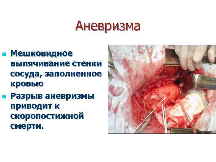 Аневризма n n Мешковидное выпячивание стенки сосуда, заполненное кровью Разрыв аневризмы приводит к скоропостижной