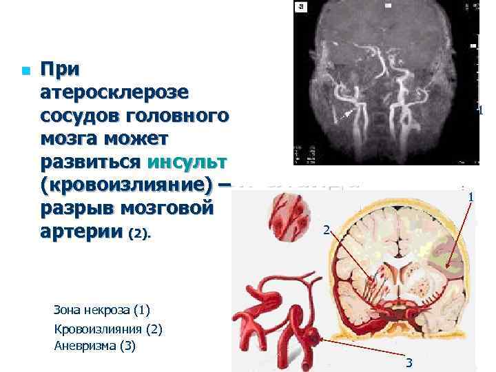 Атеросклероз сосудов головного мозга карта вызова - 88 фото