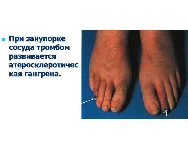 n При закупорке сосуда тромбом развивается атеросклеротичес кая гангрена. 