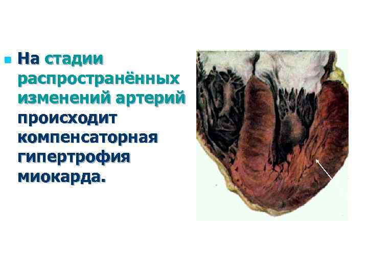 n На стадии распространённых изменений артерий происходит компенсаторная гипертрофия миокарда. 