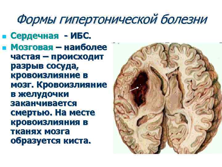 Формы гипертонической болезни n n Сердечная - ИБС. Мозговая – наиболее частая – происходит