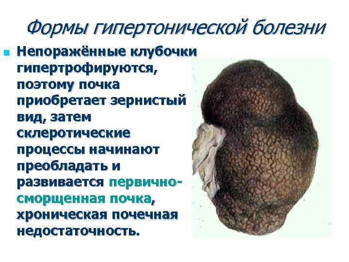 Формы гипертонической болезни n Непоражённые клубочки гипертрофируются, поэтому почка приобретает зернистый вид, затем склеротические