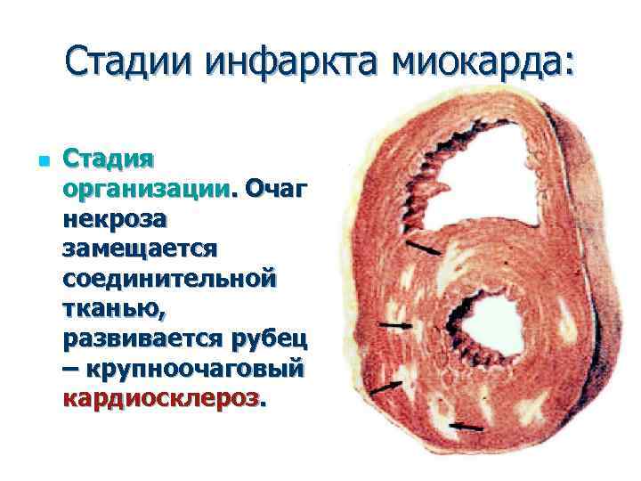 Инфаркт Миокарда Вот Такой Рубец Картинки