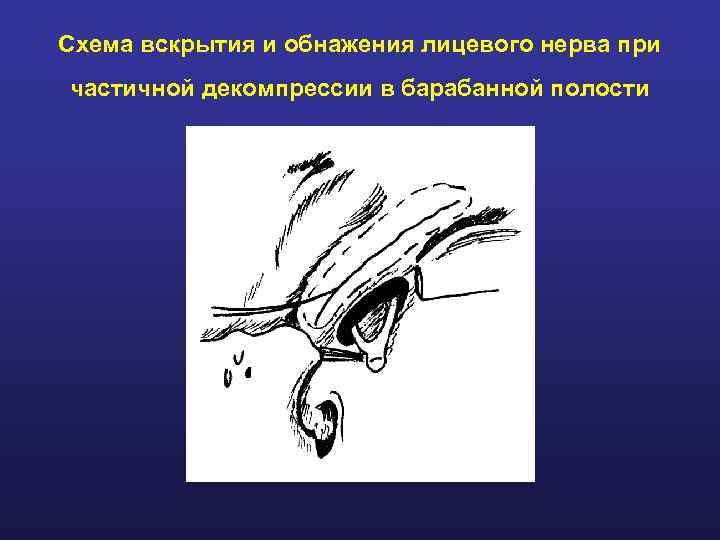 Схема вскрытия и обнажения лицевого нерва при частичной декомпрессии в барабанной полости 